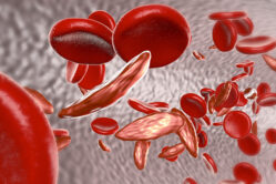 Anemia falciforme: una malattia in crescita in tutto il mondo