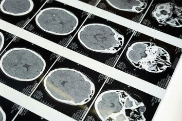 Malattie metaboliche infantili: l’interessamento del sistema nervoso è molto comune